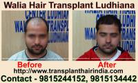 Walia Hair Transplant Ludhiana India image 3